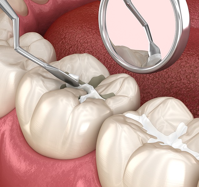 What are tooth Coloured Match Filllings | Harmony Family Dental Care | Springbank General and Family Dentist